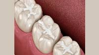 Dental Fillings