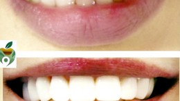 Before and After Veneers