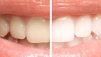 Teeth Whitening